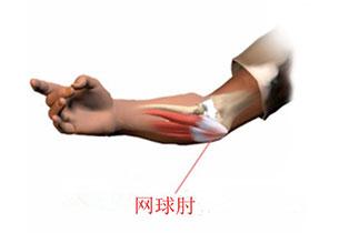网球肘到底是什么 网球肘到底是什么