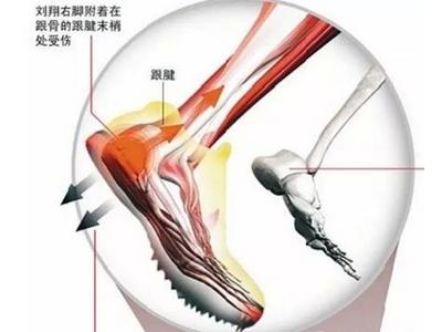 跟腱炎.jpg 跟腱炎.jpg