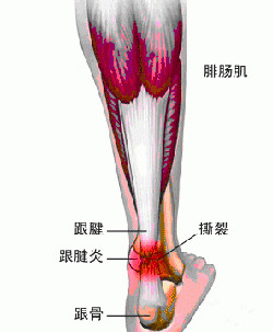 跟腱炎保健.jpg 跟腱炎保健.jpg