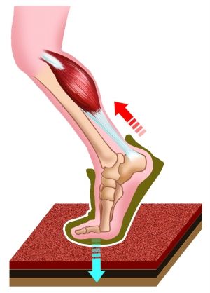 跟腱治疗.jpg 跟腱治疗.jpg