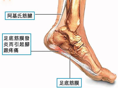 跟腱炎症状.jpg 跟腱炎症状.jpg