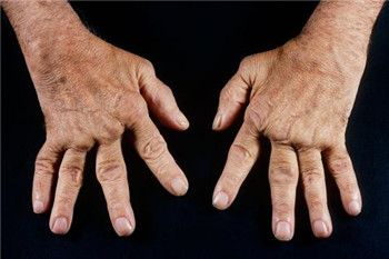 类风湿6.jpg 类风湿6.jpg