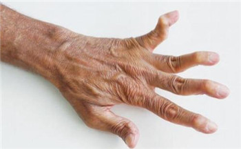 类风湿5.jpg 类风湿5.jpg