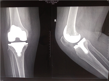 膝关节置换_副本.jpg