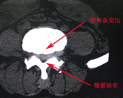 椎管狭窄影像.png 椎管狭窄影像.png