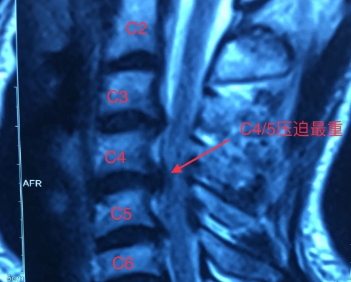 神经根型颈椎病.png 神经根型颈椎病.png