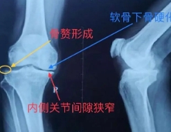 骨性关节炎.png 骨性关节炎.png